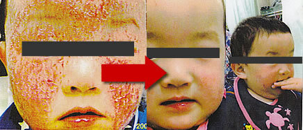 アトピー性皮膚炎の赤ちゃんの写真